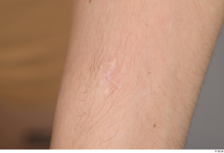 Bryton arm scar 0001.jpg